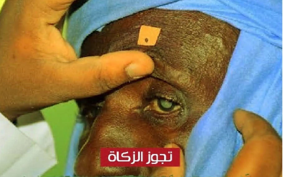 عمليات العيون بأفريقيا للفقراء والمحتاجين - جمعية الشيخ عبدالله النوري الخيرية